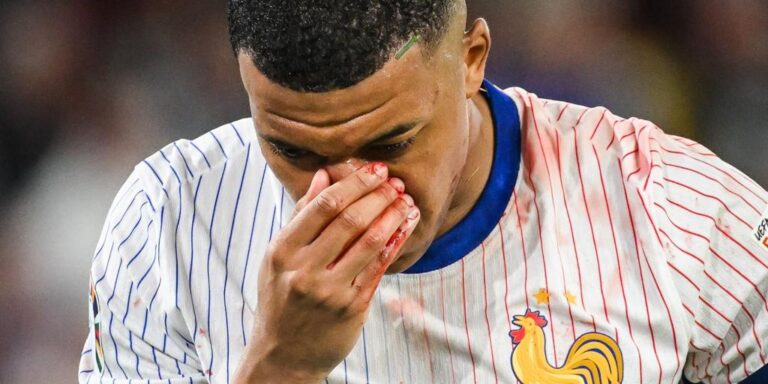 Kylian Mbappé tiene la nariz rota y podría pasar por el quirófano