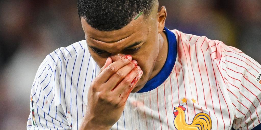 Kylian Mbappé tiene la nariz rota y podría pasar por el quirófano