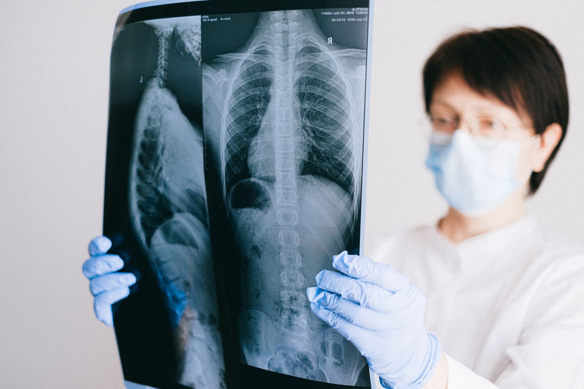 Adenocarcinoma pulmonar: el tumor más frecuente y el tratamiento aplicado al Papa León XIV